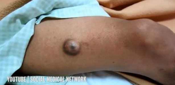 Hết hồn khối u “quái thú” giống như đôi mắt người - 1 Hết hồn khối u “quái thú” giống như đôi mắt người - 1