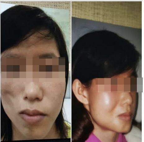 
Gương mặt trước và sau can thiệp.
