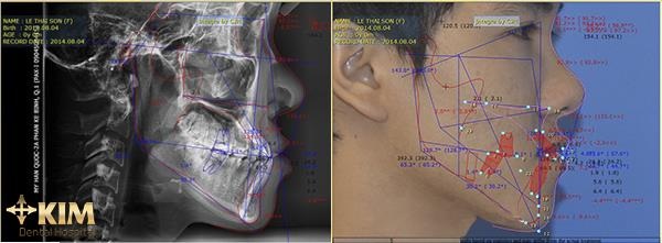 Niềng răng đúng quy trình như thế nào? - 3
Phần mềm phân tích niềng răng hô Vceph tại KIM Dental Hospital để đưa ra kiết quả niềng răng trước khi bước vào giai đoạn gắn mắc cài hoặc invisalign