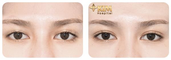 Tạo mắt 2 mí không cần phẫu thuật nhờ bấm mí - 3 Khách hàng bấm mí tại bệnh viện KIM sở hữu nếp mí đều đẹp tự nhiên và không để lại sẹo nhờ sử dụng chỉ khâu chuyên dụng.