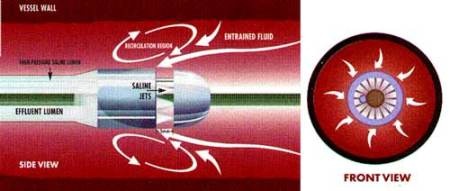 Thuyên tắc mạch phổi vì sao đáng sợ? - 2
Dụng cụ hút khối máu đông