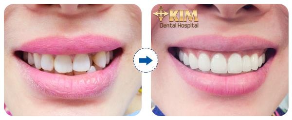 Bọc răng sứ không cần mài răng tại Bệnh viện Răng Hàm Mặt Sài Gòn - 3 Bọc răng sứ không cần mài răng tại Bệnh viện Răng Hàm Mặt Sài Gòn - 3