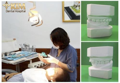 Bọc răng sứ không cần mài răng tại Bệnh viện Răng Hàm Mặt Sài Gòn - 4 Bọc răng sứ không cần mài răng tại Bệnh viện Răng Hàm Mặt Sài Gòn - 4
