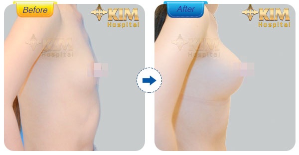 Nâng ngực nội soi 3D: Những hệ lụy bạn cần biết - 4