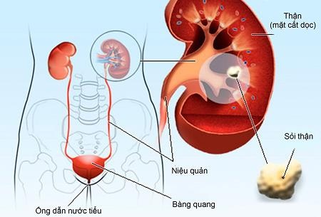7 bước để ngăn ngừa bệnh sỏi thận vào mùa hè - 1
7 Bước để ngăn ngừa bệnh sỏi thận vào mùa hè ( Ảnh minh họa)