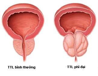 Giải pháp nào cho bệnh phì đại tuyến tiền liệt ở nam giới ? - 1 Giải pháp nào cho bệnh phì đại tuyến tiền liệt ở nam giới ? - 1