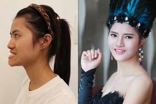 'Phép màu sắc đẹp' thay đổi trang đời - 7 Xem quá trình phẫu thuật của Hoàng Thị Hiên tại đây.