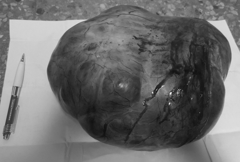 
Khối u khủng trong bụng bà C. vừa được các bác sỹ Bệnh viện Hữu nghị Việt Nam - Cu Ba Đồng Hới phẫu thuật thành công
