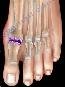 Đau ngón chân cái: Bệnh gì? - 2