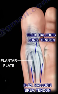 Đau ngón chân cái: Bệnh gì? - 5
