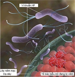 Vi khuẩn HP - Thủ phạm gây các bệnh lý dạ dày nguy hiểm - 1
Ảnh minh hoạ