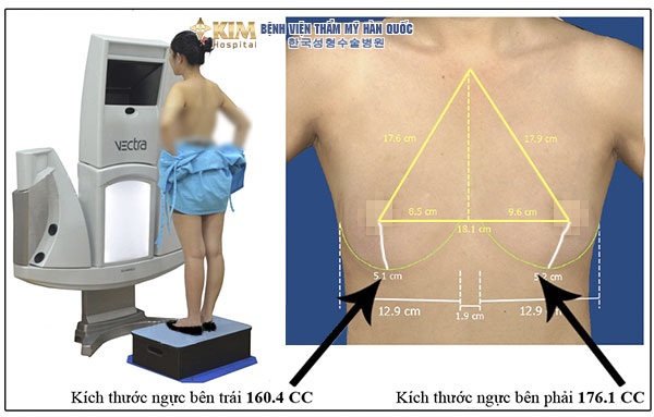 Quy trình nâng ngực nội soi an toàn tại bệnh viện thẩm mỹ hàn quốc KIM - 2 Công nghệ Vectra 3D đưa ra hình ảnh mô phỏng khuôn ngực chuẩn sau phẫu thuật, kích cỡ cụ thể phù hợp tạo vẻ đẹp quyến rũ tự nhiên.