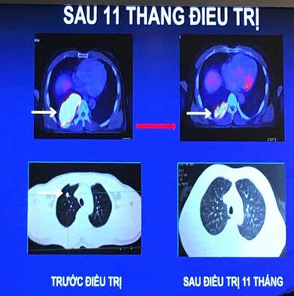 70% ca ung thư phổi phát hiện ở giai đoạn muộn - 1
Trường hợp bệnh nhân 67 tuổi sau 11 tháng điều trị cho hiệu quả rất rõ rệt