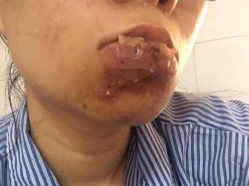 Một cô gái bị hoại tử môi vì tiêm chất làm đầy ở spa | Báo Dân trí