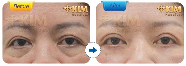Lấy bọng mỡ mắt: Bí quyết lấy lại tuổi thanh xuân của chị em U40 - 3 Đôi mắt trẻ trung, tự nhiên sau khi thực hiện tiểu phẫu lấy bọng mỡ mắt tại KIM Hospital.