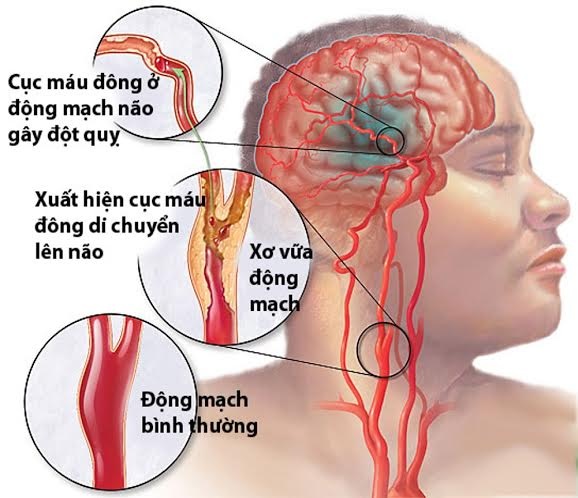 Cách nào phòng tai biến mạch máu não? - 2
Phương pháp ngăn ngừa tai biến mạch máu não. Hình minh họa