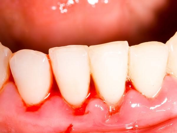 Bệnh nha chu làm tăng nguy cơ ung thư vú - 1
Phụ nữ bị bệnh nha chu tăng nguy cơ bị ung thư vú