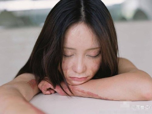 Bộ ảnh vượt qua mặc cảm của cô gái bị thiêu sống - 1 Bộ ảnh vượt qua mặc cảm của cô gái bị thiêu sống - 1