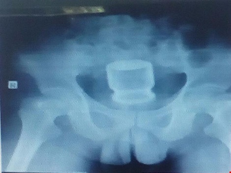 Dùng lọ nước yến thông hậu môn để trị… táo bón - 1 Hình chụp X-quang cho thấy lọ nước yến nằm sâu trong hậu môn của ông L. Ảnh: VĂN NGHĨA