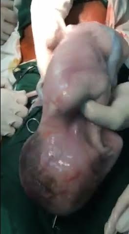 Khoảnh khắc cả 3 em bé còn nguyên trong bọc ối chui ra từ bụng mẹ - 1 Khoảnh khắc cả 3 em bé còn nguyên trong bọc ối chui ra từ bụng mẹ - 1