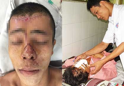 Người đứt mũi được ghép mới thành công - 1 Sau bốn tuần phẫu thuật, lỗ mũi của anh NPS trở lại bình thường (trái). Ảnh: THÁI TRUNG và BS Võ Thái Trung (phải) đang kiểm tra lỗ mũi tái tạo của ông VXL. Ảnh: TRẦN NGỌC