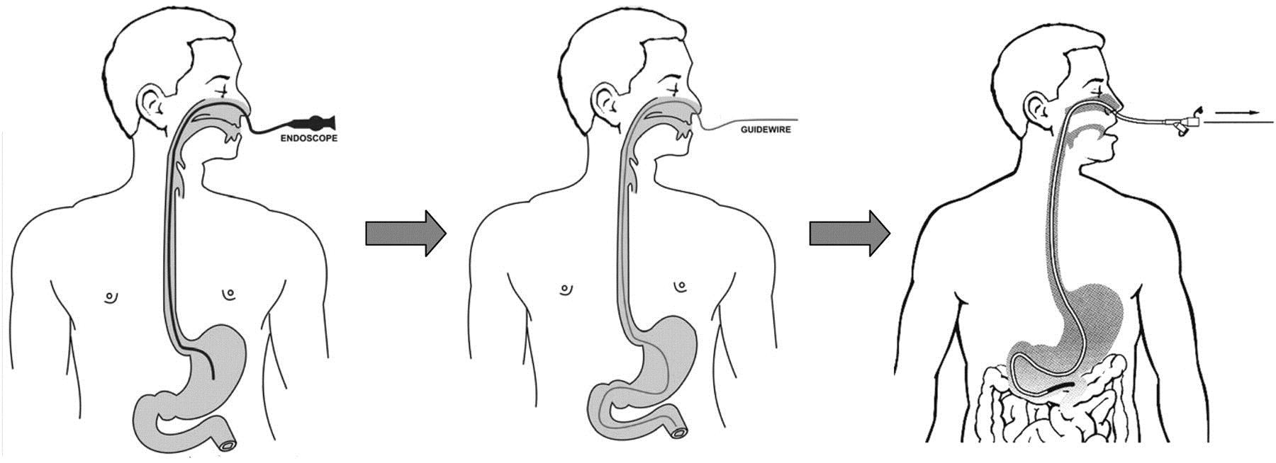 Vì sao nên nội soi dạ dày đường mũi? - 1 Nội soi dạ dày qua đường mũi