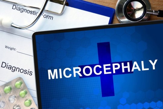 Phát hiện mới về những ca bệnh đầu nhỏ không mắc Zika - 1 Phát hiện mới về những ca bệnh đầu nhỏ không mắc Zika - 1