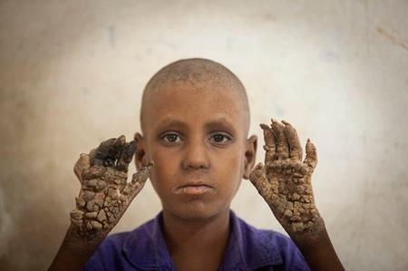 Dù mới 7 tuổi nhưng Ripon đã mắc phải căn bệnh kì lạ