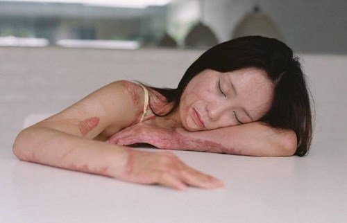 Bộ ảnh vượt qua mặc cảm của cô gái bị thiêu sống - 3 Bộ ảnh vượt qua mặc cảm của cô gái bị thiêu sống - 3
