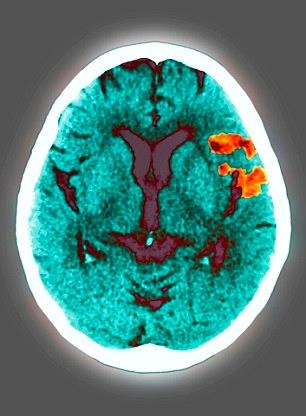 16 triệu người đang chung sống với bệnh cao huyết áp có thể dẫn đến các vấn đề như nguồn cung cấp máu từ não bị đứt gây nên bệnh đột quỵ