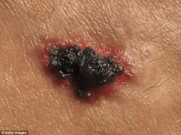 Dùng mỹ phẩm chống nắng cao giúp giảm 1/3 nguy cơ bị ung thư da - 2 Melanoma là một loại ung thư da có thể lan sang các bộ phận khác trong cơ thể, không giống như ung thư biểu mô tế bào đáy, bệnh hiếm khi lan ra chỗ khác.