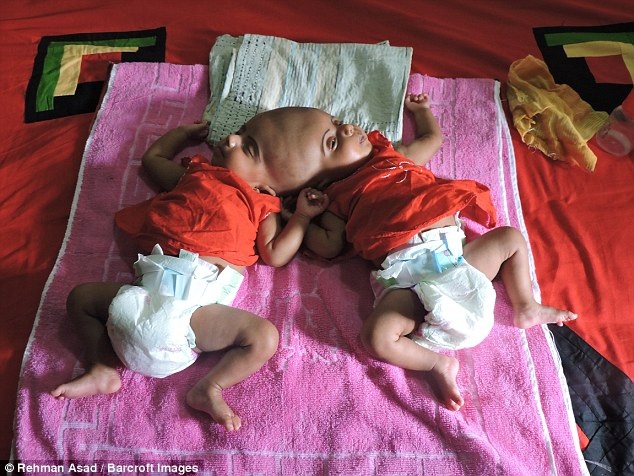 
Cặp song sinh phải chờ ít nhất 2 năm nữa để biết có thể sống độc lập với nhau hay không.
