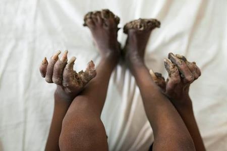 Cả tay và chân cậu bé đang dần biến thành “rễ cây”