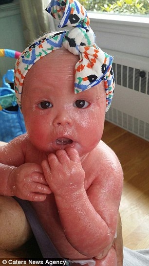 Xót xa những em bé phải chịu đau đớn vì mắc bệnh lạ về da - 5
Cô bé đang sắp đón lần sinh nhật đầu tiên của cuộc đời mình.