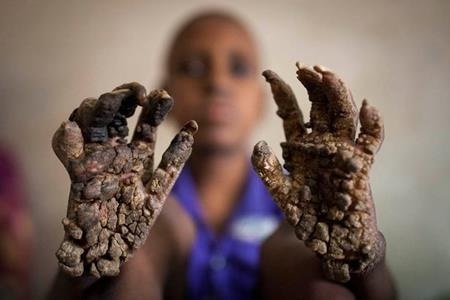 Ripon gặp phải nhiều khó khăn trong đi lại và ăn uống