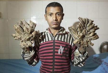 Bệnh viện đại học y Dhaka từng tiến hành phẫu thuật cho người cây Abul