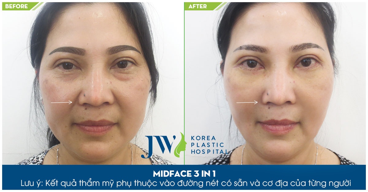 Hình ảnh trước và sau khi phẫu thuật Midface của khách hàng tại Bệnh viện thẩm mỹ JW Hàn Quốc.