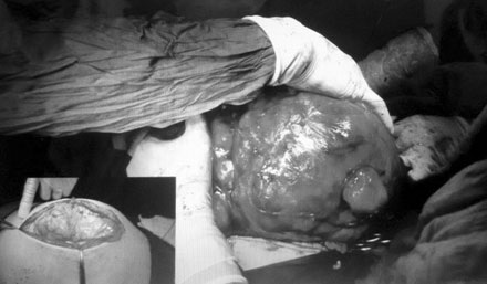 
Bác sĩ thực hiện cuộc phẫu thuật bóc tách bướu cho người bệnh
