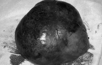 
Khối bướu sau khi được bóc khỏi ngực của bệnh nhi
