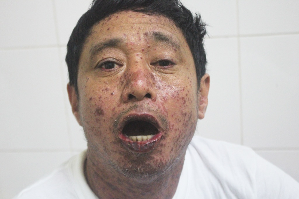 Một người nhập viện sau khi ăn cá nục kho - 2 Các nốt ban đỏ khắp mặt, cổ, miệng bị lở loét khiến bệnh nhân không thể ăn hay nuốt được.