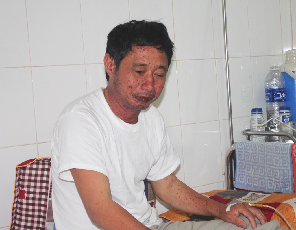 Một người nhập viện sau khi ăn cá nục kho - 1 Bệnh nhân Trương Như La hiện đang điều trị tại Bệnh viện đa khoa Tp Vinh với những triệu chứng dị ứng sau khi ăn cá biển.