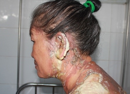 Vùng lỗ tai bà L. bị nặng nhất, không thể nghe được sau khi bị tạt nước sôi