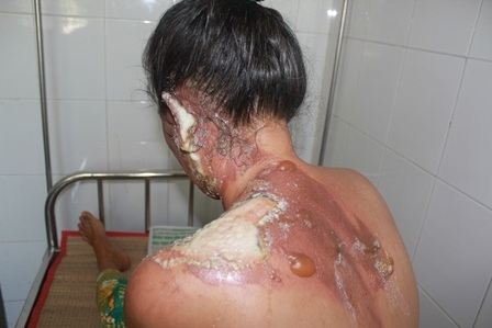 Bà L. đang điều trị tại bệnh viện