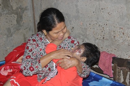 Mẹ nghèo thắt ruột nhìn các bộ phận trên mặt con bị lở loét, ăn mòn - 5