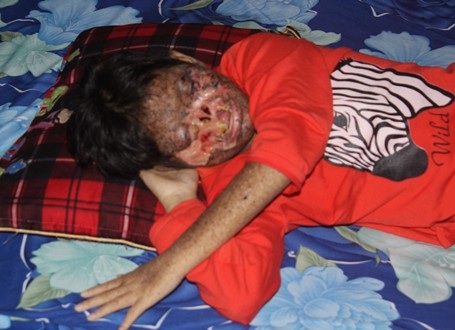 Mẹ nghèo thắt ruột nhìn các bộ phận trên mặt con bị lở loét, ăn mòn - 7