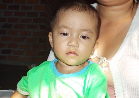 Cháu Sơn, con chị Ngân bị bệnh tim bẩm sinh phức tạp và các bác sỹ cho biết cháu sẽ còn thêm 2 lần phẫu thuật nữa mới khỏi hẳn