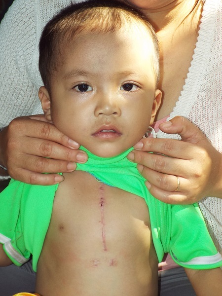Vết mổ tim hồi tháng 9/2015 của cháu Sơn tại bệnh viện TƯ Huế