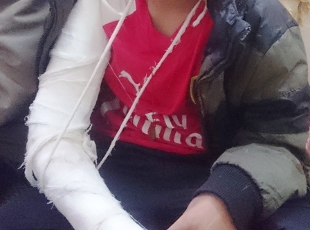 
Em Anh cho biết bị thầy giáo dùng gậy tre đánh gãy tay
