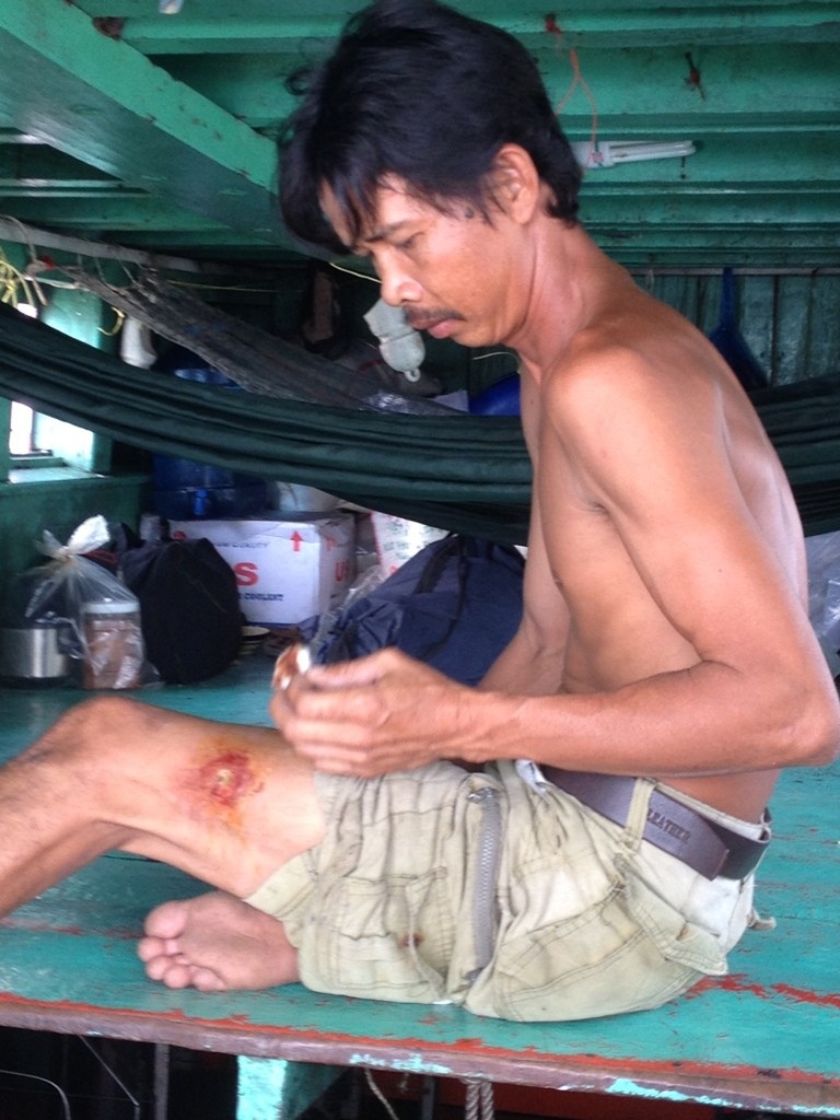 Ngư dân Kiên Giang làm hồ sơ khởi kiện cảnh sát biển Thái Lan - 2
Ngư dân Trần Văn Sáng cũng bị trúng đạn ở đùi, đã xuất viện