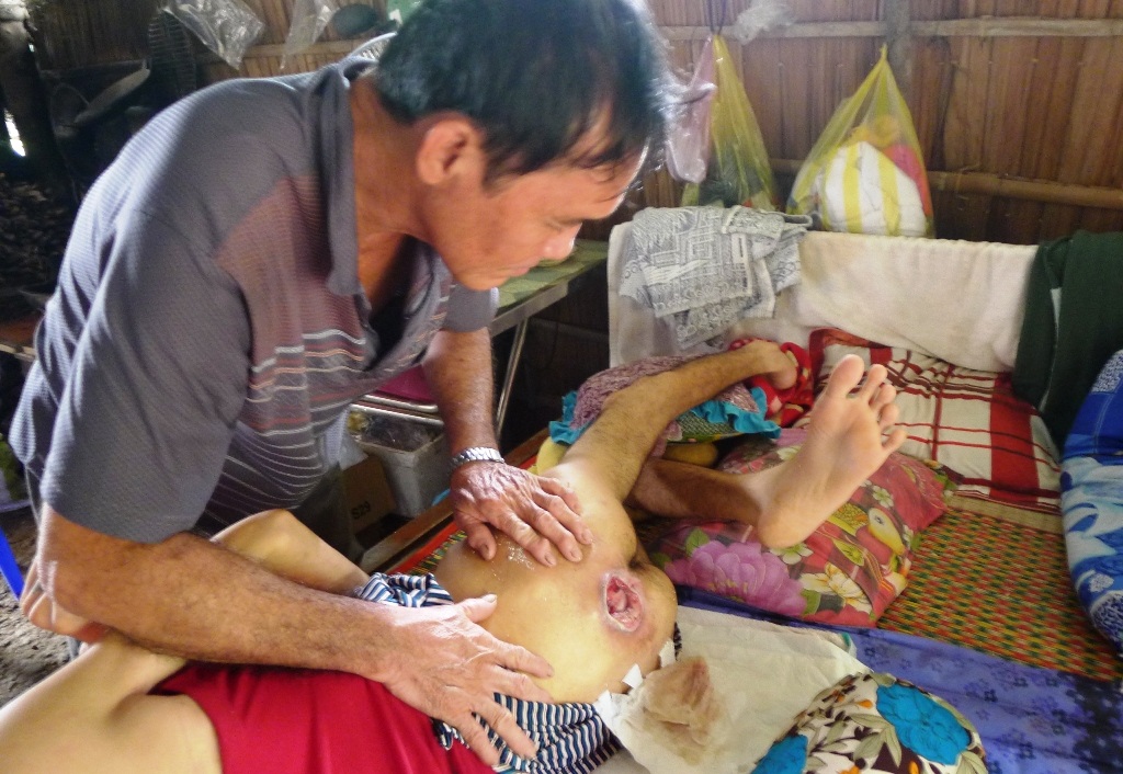 "Nghe tiếng kêu đau của vợ con, tôi thấy mình ngã quỵ" - 4
Hiện vết lở loét ở đốt xương cùng của em Hoàng Kim đã sâu và rộng như thế này